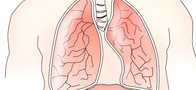 Husten, Bronchitis & COPD