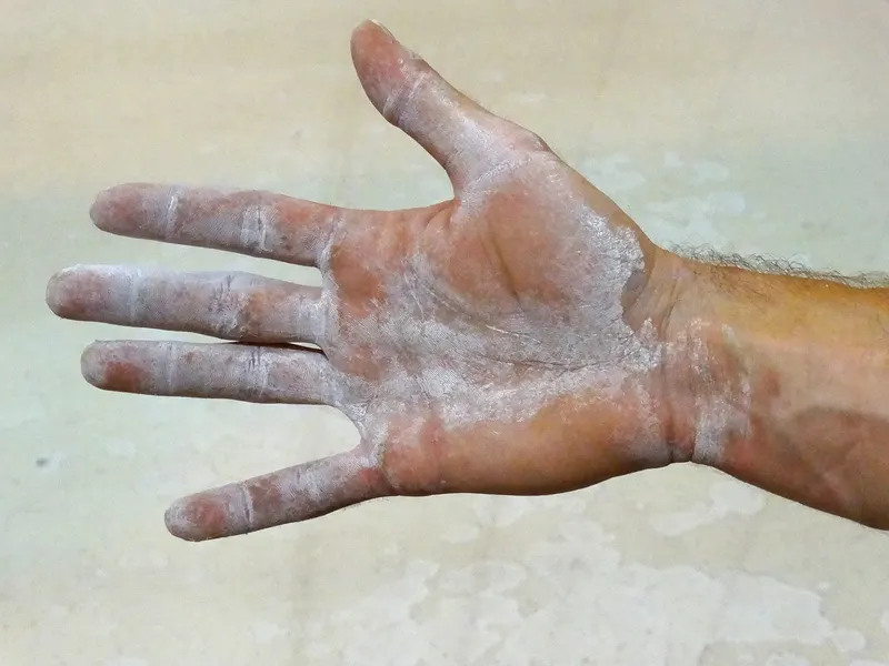 Magnesiummangel